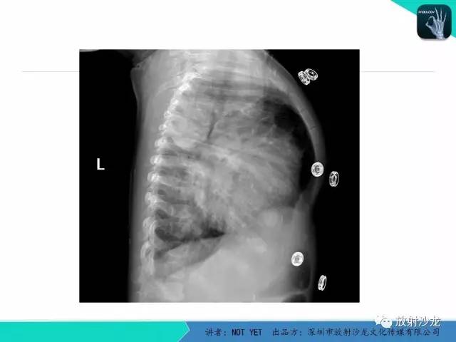 【病例】纵膈疝1例X线CT影像表现