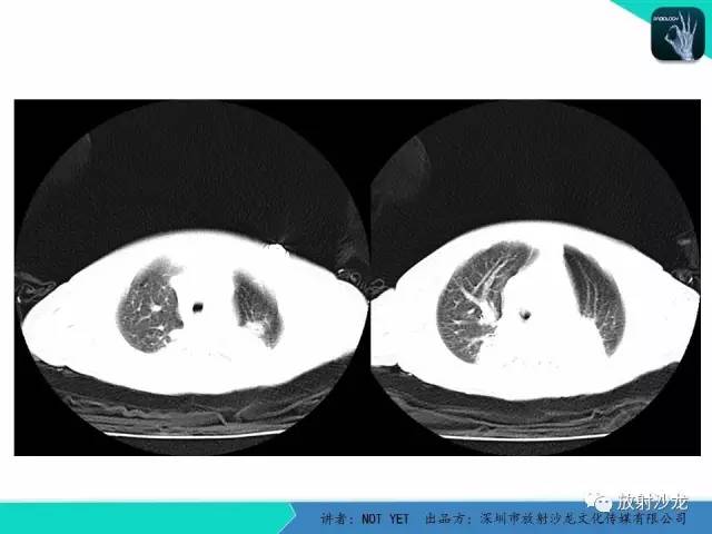 【病例】纵膈疝1例X线CT影像表现