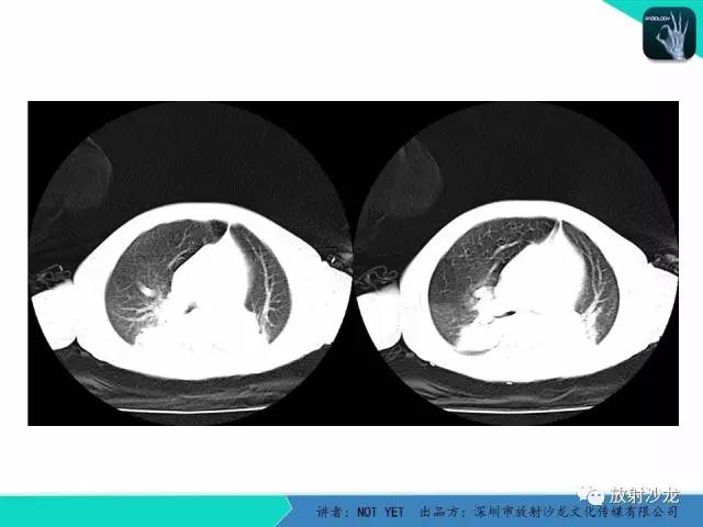 【病例】纵膈疝1例X线CT影像表现