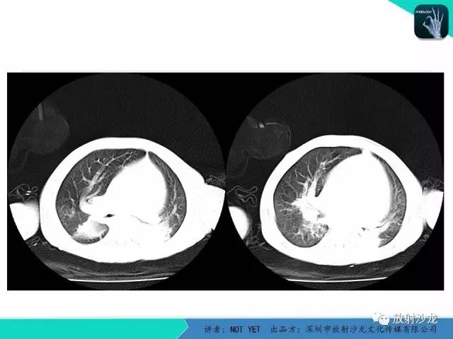 【病例】纵膈疝1例X线CT影像表现
