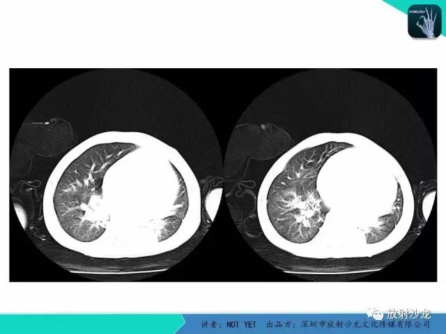 【病例】纵膈疝1例X线CT影像表现