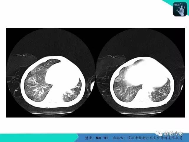 【病例】纵膈疝1例X线CT影像表现