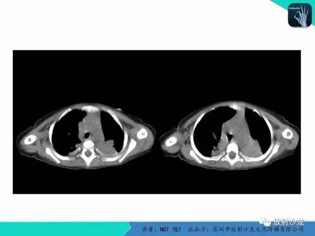 【病例】纵膈疝1例X线CT影像表现