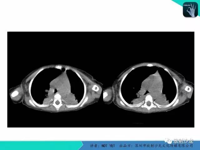 【病例】纵膈疝1例X线CT影像表现