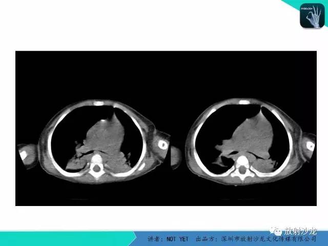 【病例】纵膈疝1例X线CT影像表现