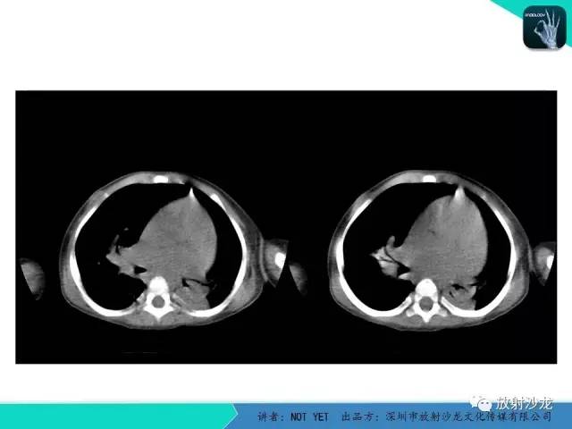 【病例】纵膈疝1例X线CT影像表现