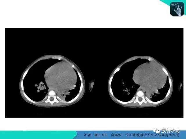 【病例】纵膈疝1例X线CT影像表现
