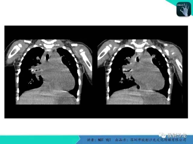 【病例】纵膈疝1例X线CT影像表现