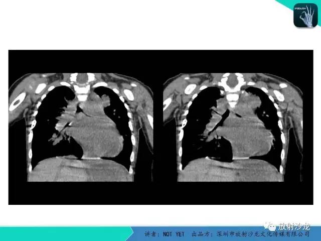 【病例】纵膈疝1例X线CT影像表现
