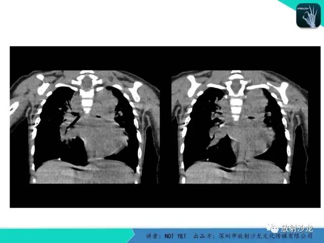 【病例】纵膈疝1例X线CT影像表现