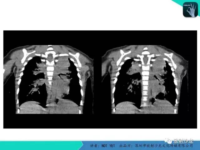 【病例】纵膈疝1例X线CT影像表现