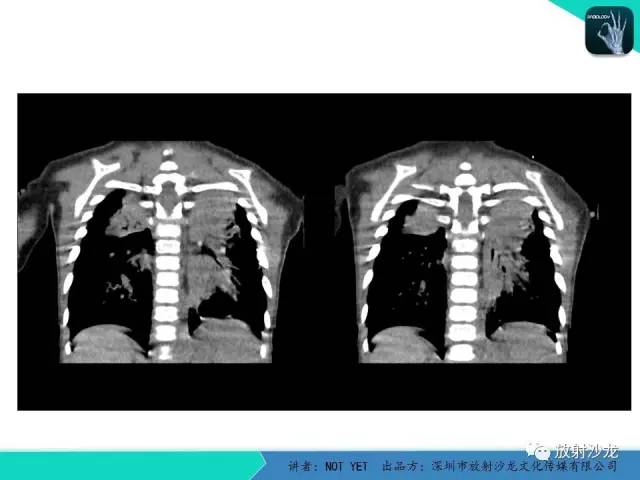【病例】纵膈疝1例X线CT影像表现