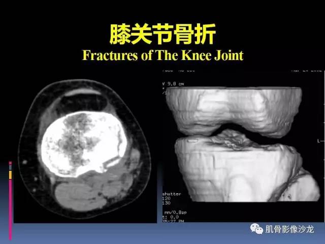 【PPT】膝关节病变影像学诊断