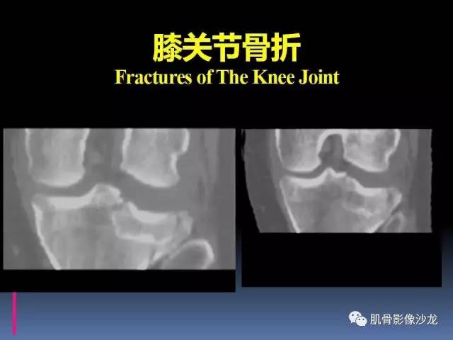 【PPT】膝关节病变影像学诊断