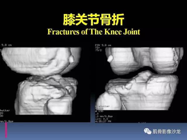 【PPT】膝关节病变影像学诊断