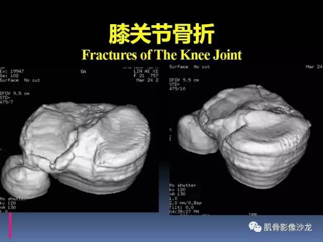 【PPT】膝关节病变影像学诊断