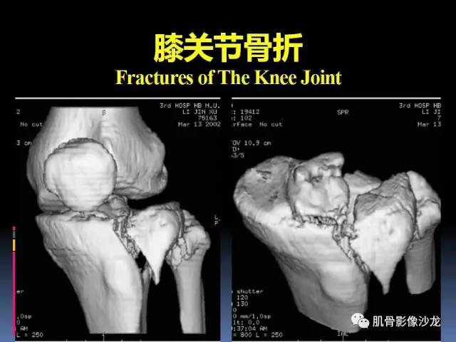 【PPT】膝关节病变影像学诊断