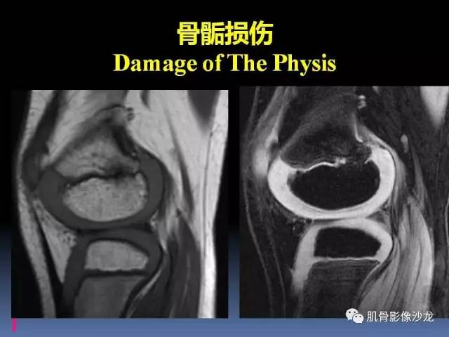 【PPT】膝关节病变影像学诊断