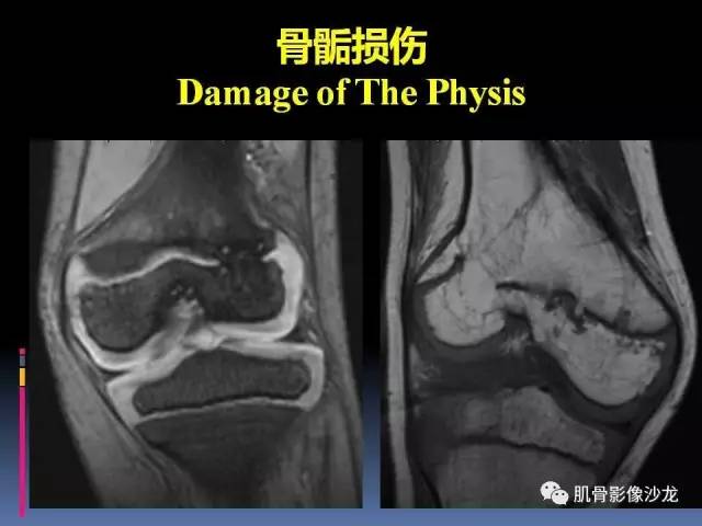 【PPT】膝关节病变影像学诊断