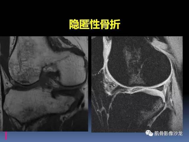 【PPT】膝关节病变影像学诊断