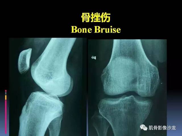 【PPT】膝关节病变影像学诊断