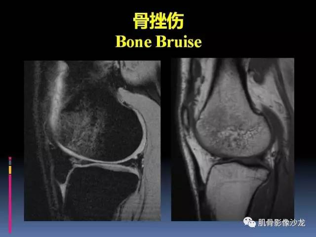 【PPT】膝关节病变影像学诊断