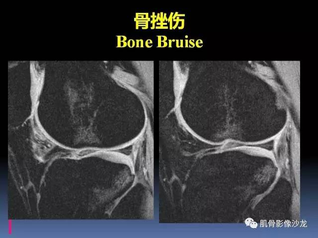 【PPT】膝关节病变影像学诊断
