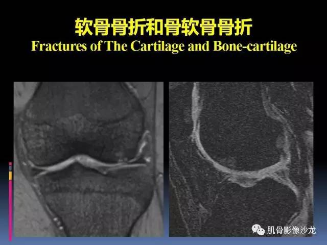 【PPT】膝关节病变影像学诊断
