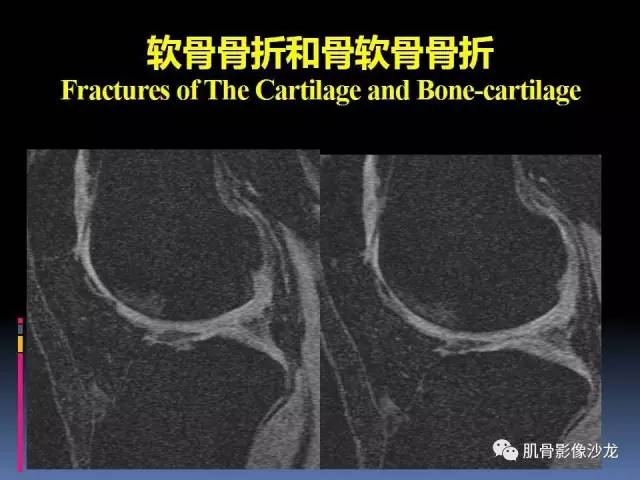 【PPT】膝关节病变影像学诊断