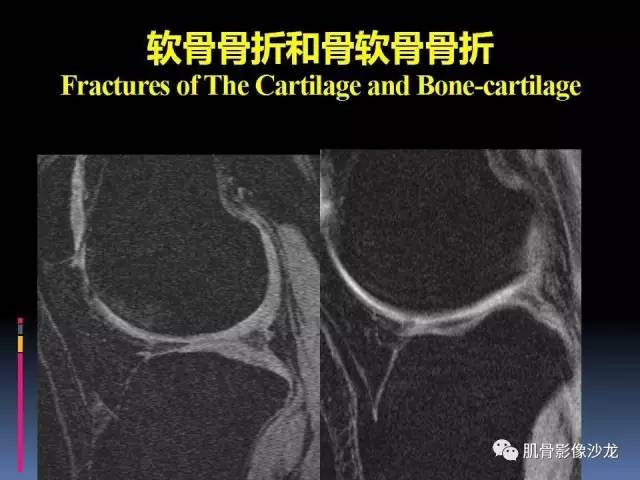【PPT】膝关节病变影像学诊断