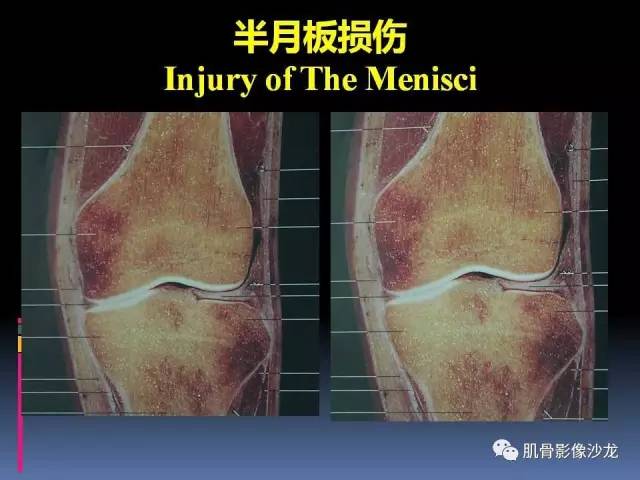 【PPT】膝关节病变影像学诊断