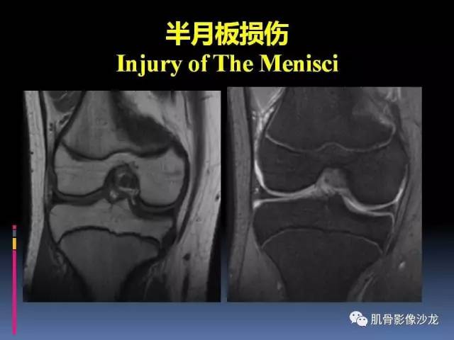【PPT】膝关节病变影像学诊断