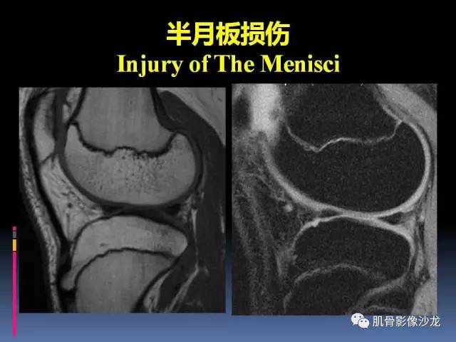 【PPT】膝关节病变影像学诊断