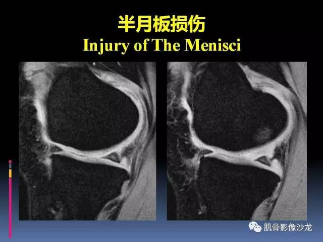【PPT】膝关节病变影像学诊断