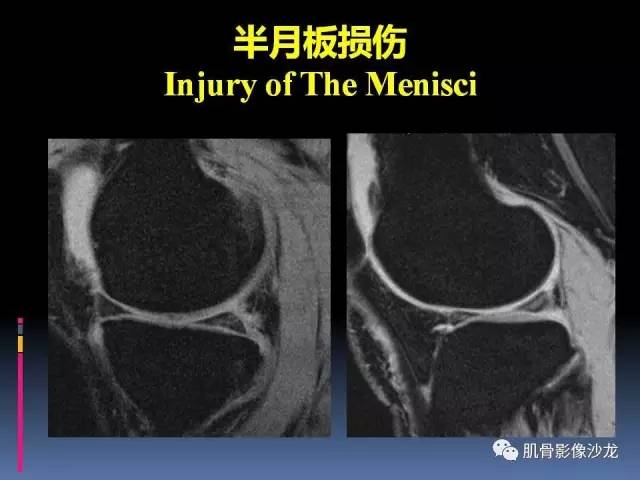 【PPT】膝关节病变影像学诊断