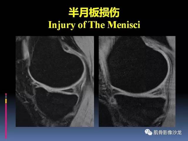 【PPT】膝关节病变影像学诊断