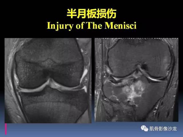 【PPT】膝关节病变影像学诊断