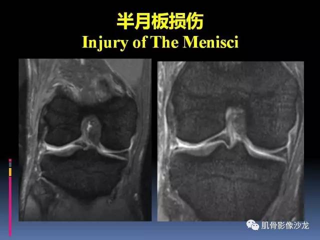 【PPT】膝关节病变影像学诊断