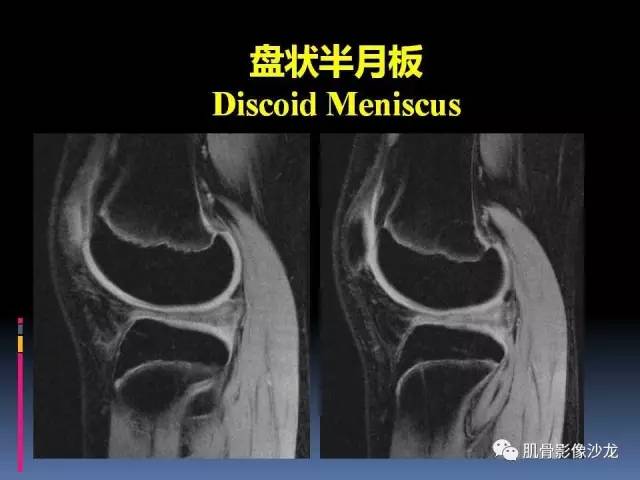 【PPT】膝关节病变影像学诊断