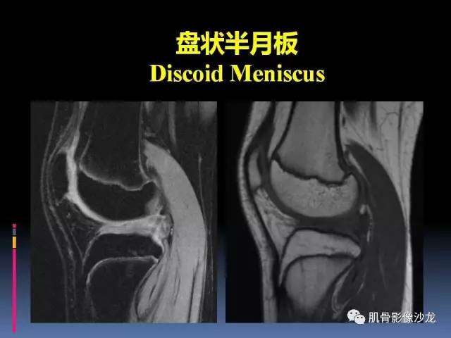【PPT】膝关节病变影像学诊断