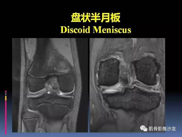 【PPT】膝关节病变影像学诊断