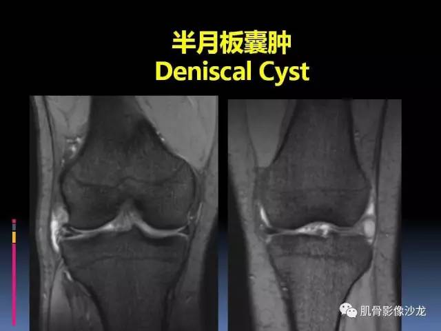 【PPT】膝关节病变影像学诊断