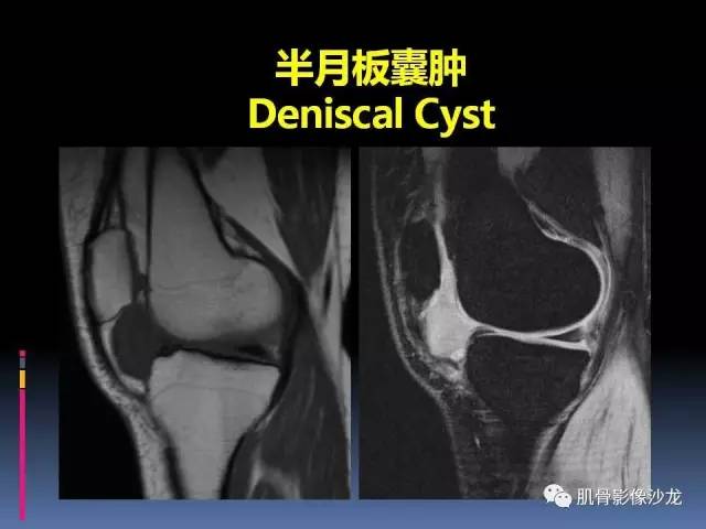 【PPT】膝关节病变影像学诊断