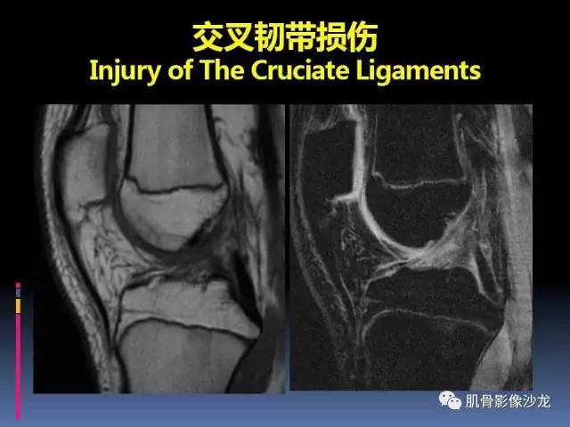 【PPT】膝关节病变影像学诊断