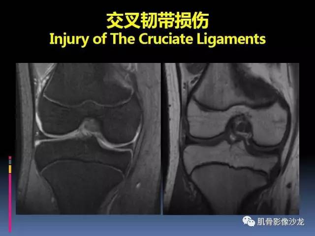 【PPT】膝关节病变影像学诊断