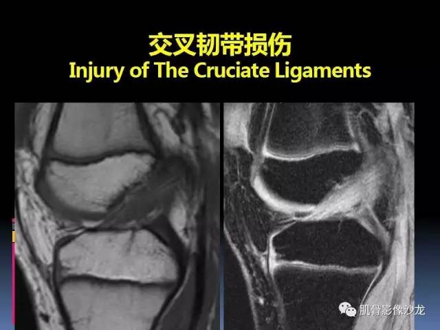 【PPT】膝关节病变影像学诊断
