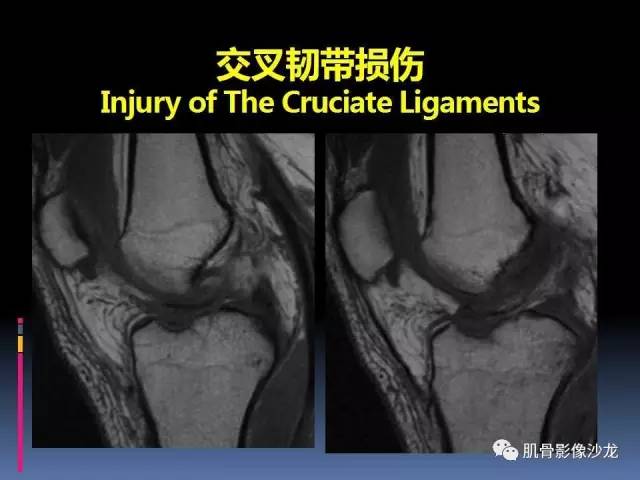 【PPT】膝关节病变影像学诊断