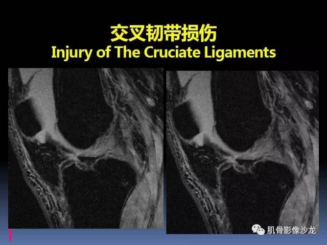 【PPT】膝关节病变影像学诊断