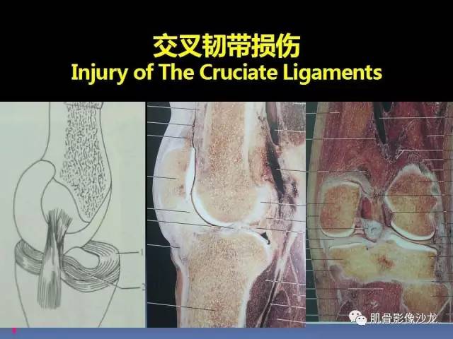 【PPT】膝关节病变影像学诊断