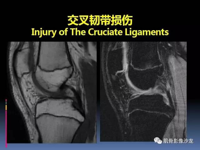 【PPT】膝关节病变影像学诊断